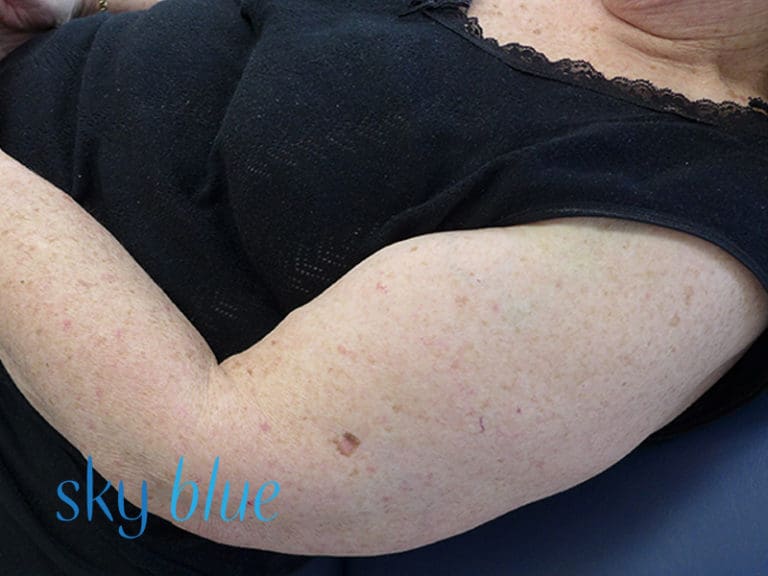 Melanoma Upper Arm A Sky Blue Dermatology