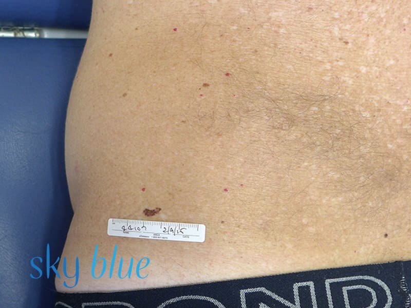 Melanoma lower back 1ax