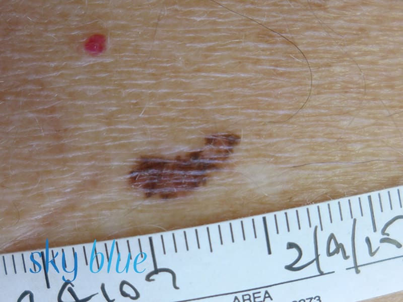 Melanoma 1b (close up)