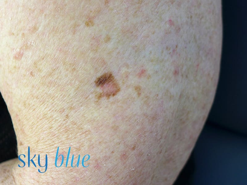 Skin Cancer White Spots On Arms | Images and Photos finder