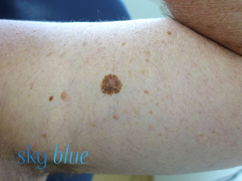 Melanoma upper arm 3b
