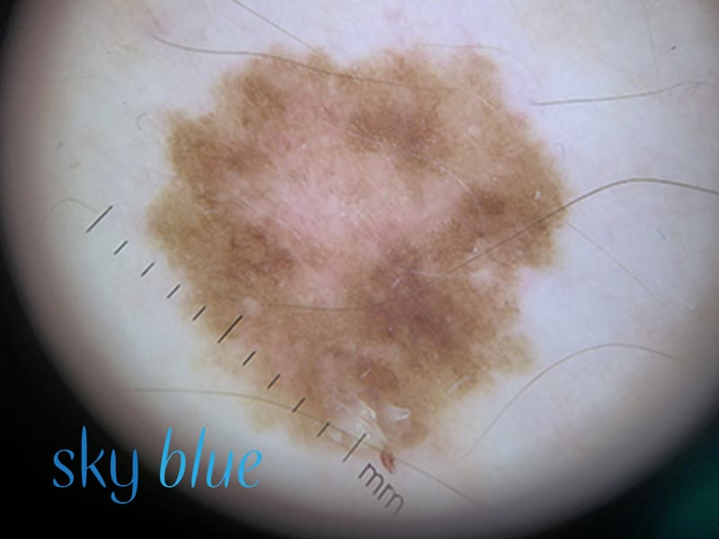 Melanoma upper arm 3c (close up)