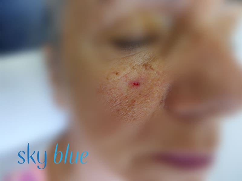 Nodular BCC
