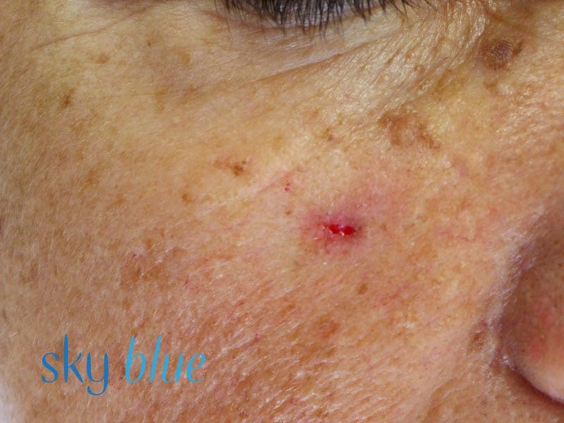 Nodular BCC 2x (close Up)