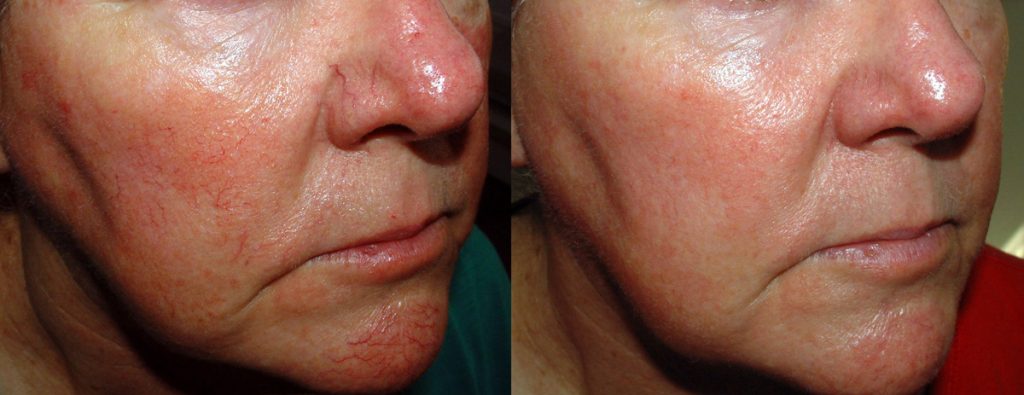 Cosmetic - Facial telangiectasia pre and post-MaxG IPL treatment