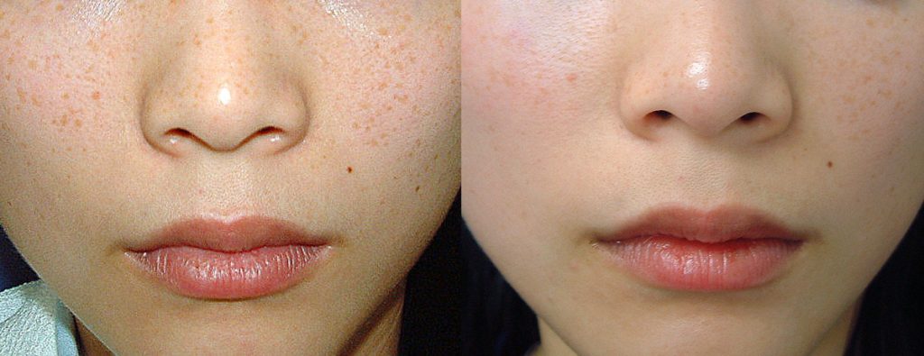 Cosmetic - Freckles pre and post ExcelV laser