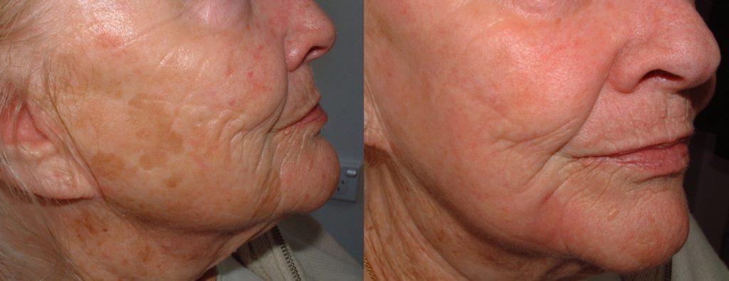 Cosmetic - Sundamage pre and post TCA chemical peel