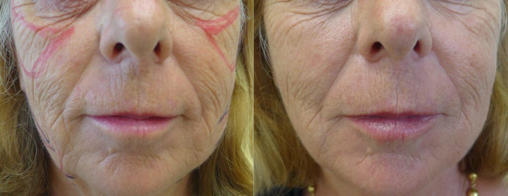 Cosmetic - Rejuvenation with thread lifts (lower face) and dermal filler for malar cheeks