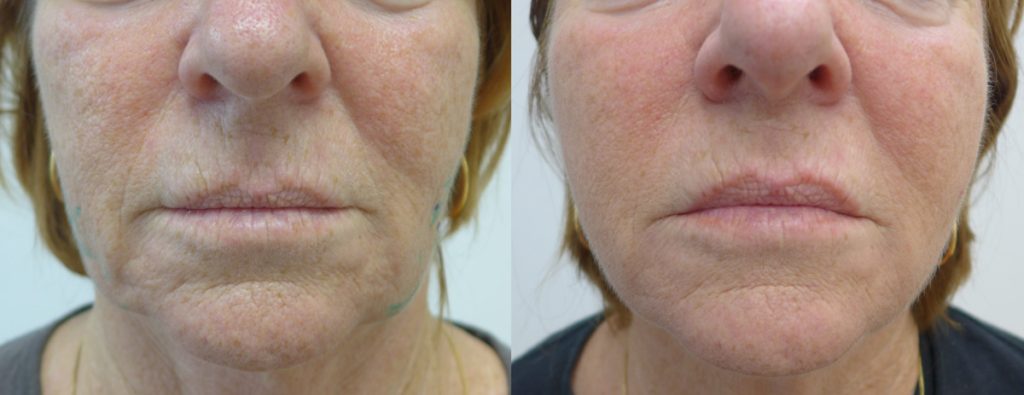 Cosmetic - Lower face lift with Mint threads